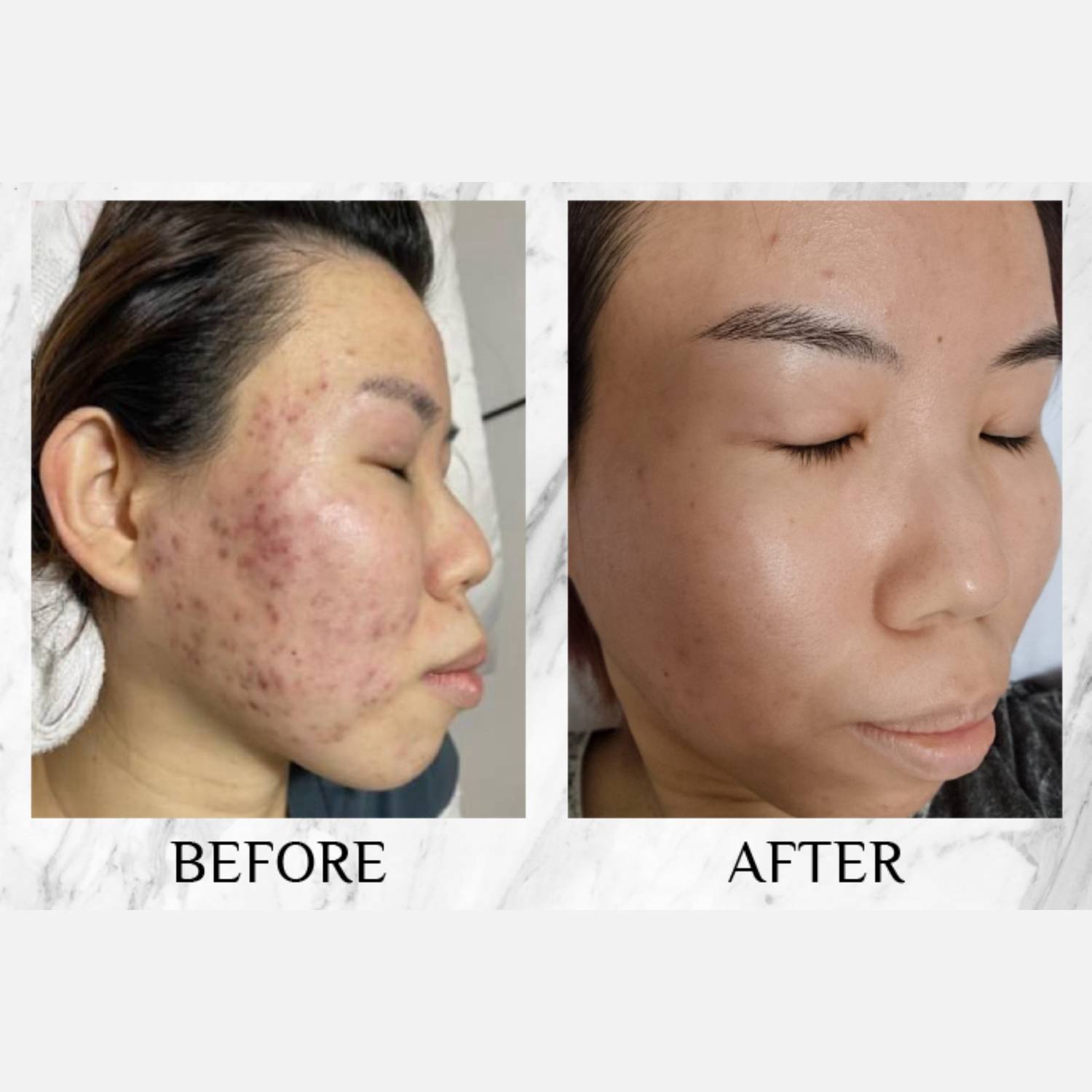 Avene anti blemish moisturizer gel جێڵی شێدارکەرەوەی دژە زیپکەی ئەڤێن