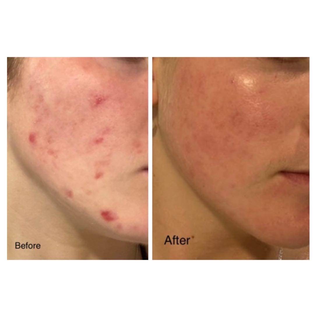 Neutrogena anti-pimple faical cleansing غسولی نیوترۆجینەی دژە زیپکە