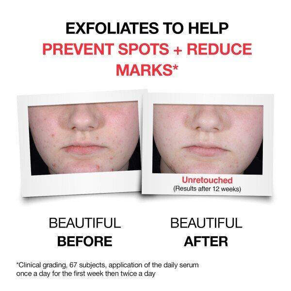 Neutrogena salislic acid %4 PHA غسولی تەقشیری نیوترۆجینە