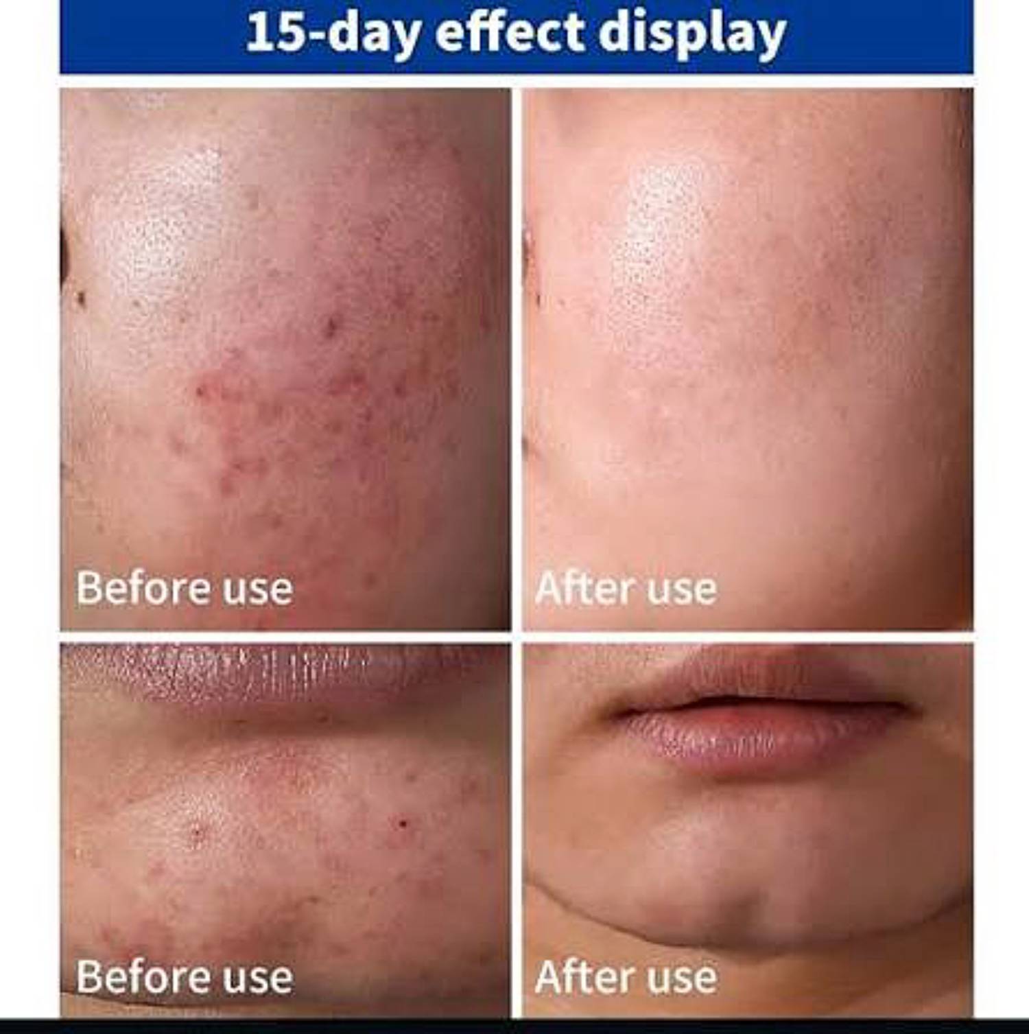 La roche-posay cicaplast baume b5 سیکاپلاستی لارۆش پۆزەی