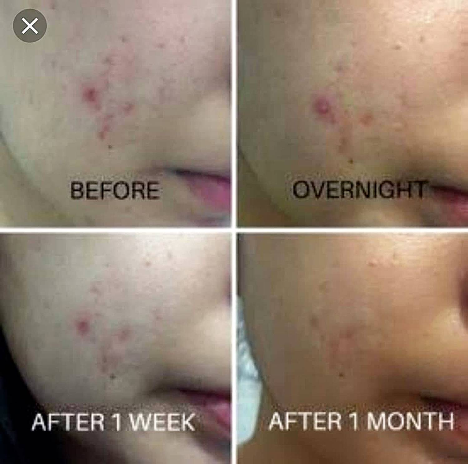 Cosrx centela blemish control cream کرێمی سێنتێلای دژە زیپکەی کۆزارێکس